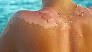 Güneş Yanıklarına Dikkat!