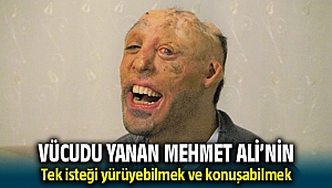 Küçükken yanan Mehmet Ali'nin tek isteği yürüyebilmek ve konuşabilmek