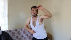 Hidradenitis hastası Enver tedavi olmak istiyor